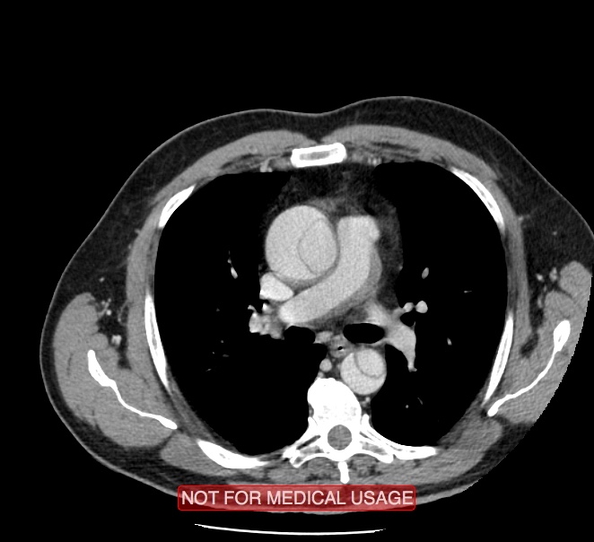 Acute aortic dissection - Stanford type A (Radiopaedia 40661-43285 Axial C+ portal venous phase 19).jpg