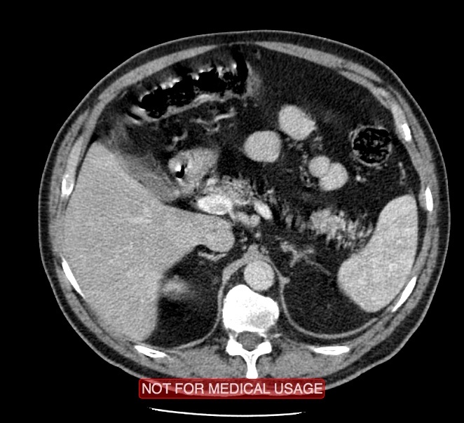 Acute aortic dissection - Stanford type A (Radiopaedia 40661-43285 Axial C+ portal venous phase 81).jpg