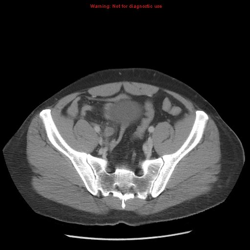 Acute appendicitis (Radiopaedia 10498-10973 Axial C+ portal venous phase 37).jpg