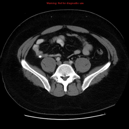 File:Acute appendicitis (Radiopaedia 12326-12607 Axial C+ portal venous phase 26).jpg