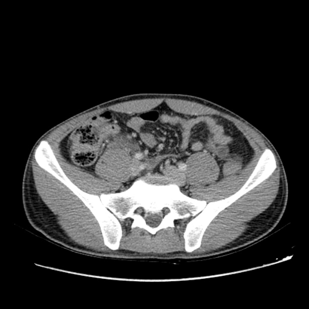 Acute appendicitis (Radiopaedia 27049-27227 Axial C+ portal venous phase 53).jpg