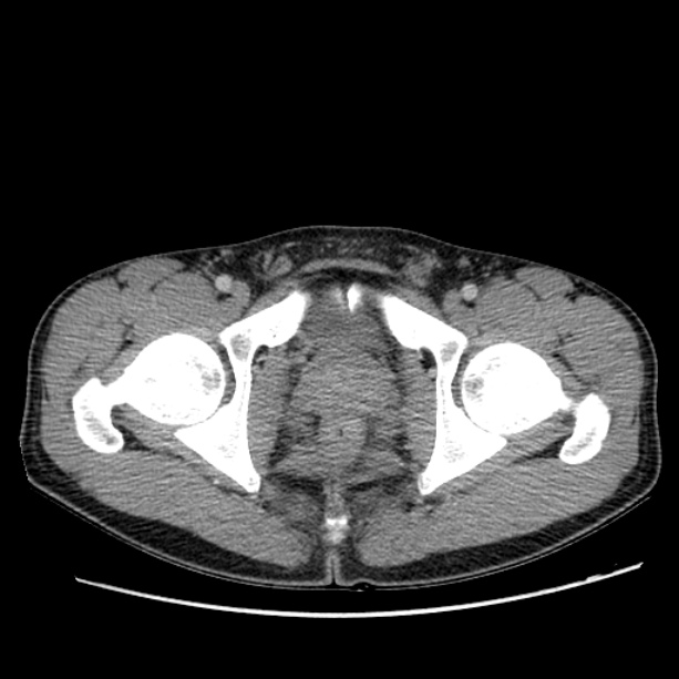 Acute appendicitis (Radiopaedia 27049-27227 Axial C+ portal venous phase 75).jpg