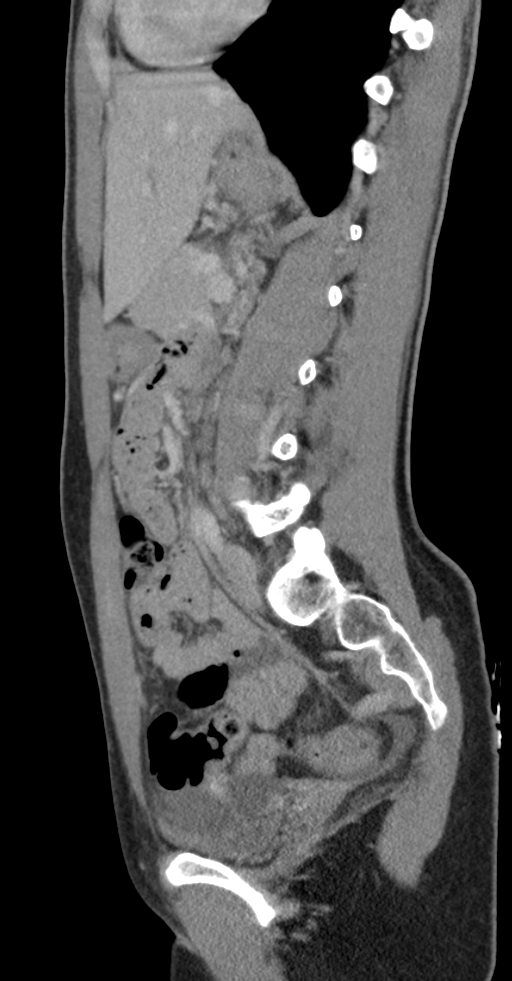 Acute appendicitis (Radiopaedia 62608-70901 Sagittal C+ portal venous phase 9).jpg