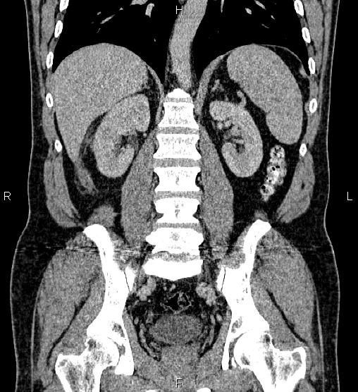Acute appendicitis (Radiopaedia 84780-100240 Coronal C+ portal venous phase 54).jpg