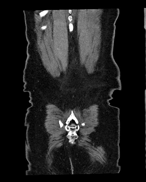 Acute appendicitis - large appendicoliths (Radiopaedia 61805-69820 Coronal C+ portal venous phase 125).jpg