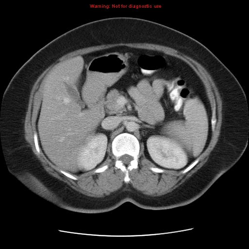 Acute appendicitis complicated by ovarian vein thrombophlebitis (Radiopaedia 16172-15851 Axial C+ portal venous phase 35).jpg