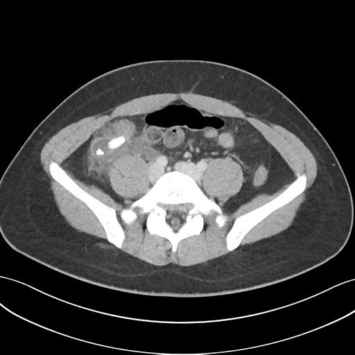 File:Acute appendicitis with appendicoliths (Radiopaedia 50186-55532 Axial C+ portal venous phase 55).png