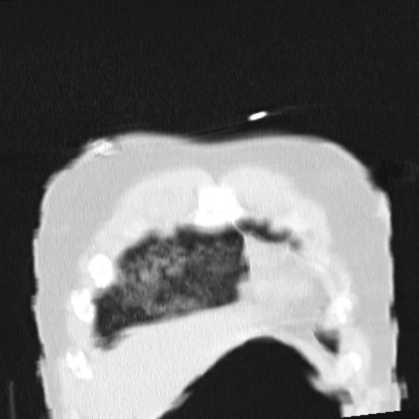 Acute aspiration pneumonitis (Radiopaedia 33605-34703 Coronal lung window 13).jpg