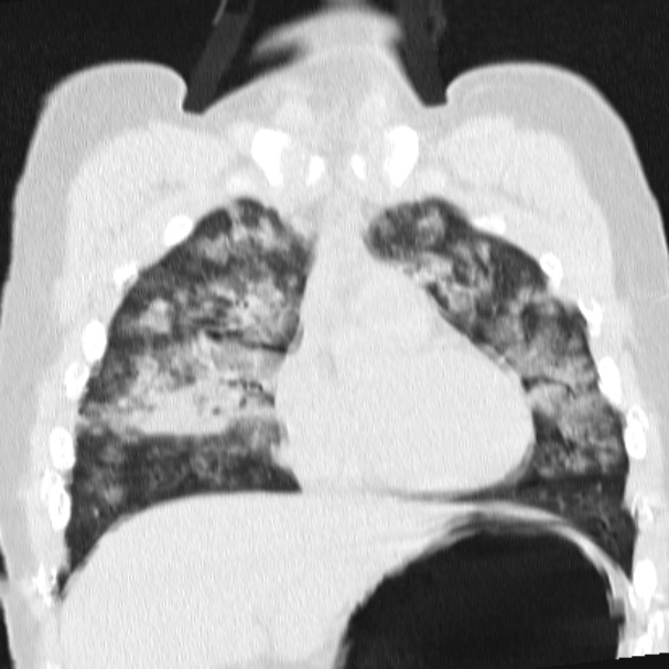 Acute aspiration pneumonitis (Radiopaedia 33605-34703 Coronal lung window 32).jpg