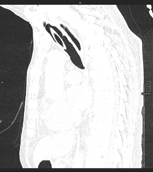 Acute aspiration pneumonitis (Radiopaedia 55642-62166 Sagittal lung window 79).jpg