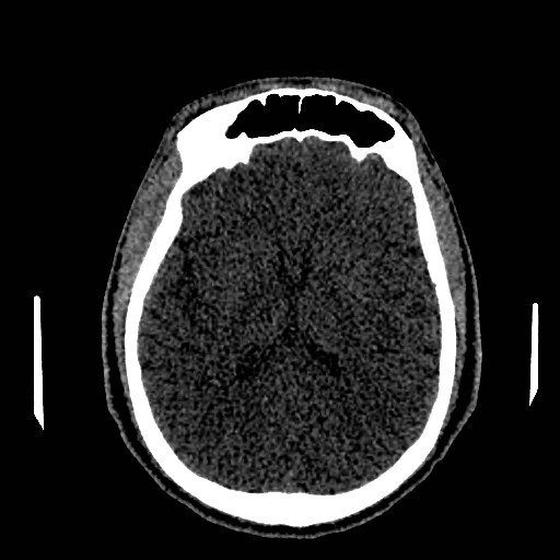 Acute basilar artery occlusion (Radiopaedia 43582-46985 Axial non-contrast 102).jpg