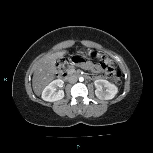 Acute bilateral pyelonephritis (Radiopaedia 37146-38881 Axial C+ arterial phase 85).jpg