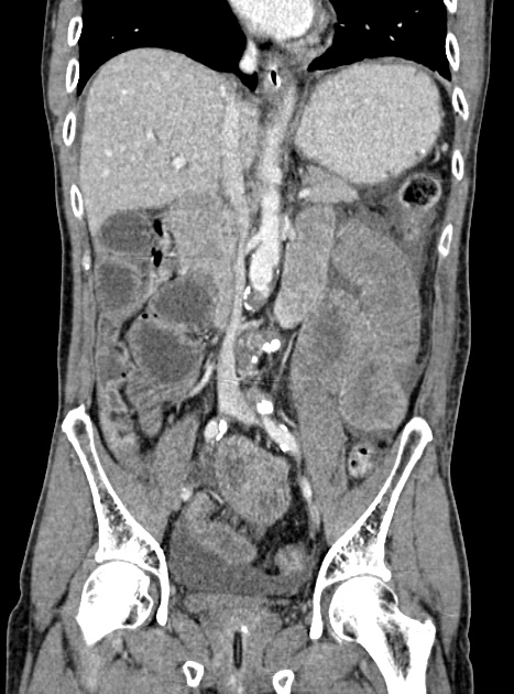 Acute bowel ischemia (Radiopaedia 87695-104114 Coronal C+ portal venous phase 210).jpg