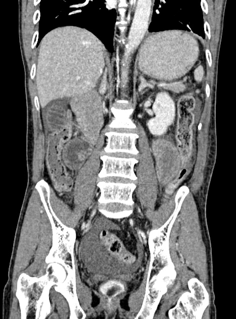 Acute bowel ischemia (Radiopaedia 87695-104114 Coronal C+ portal venous phase 240).jpg