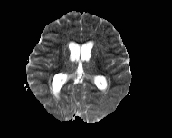 File:Acute cerebellar ataxia (Radiopaedia 61487-69446 Axial ADC 12).jpg