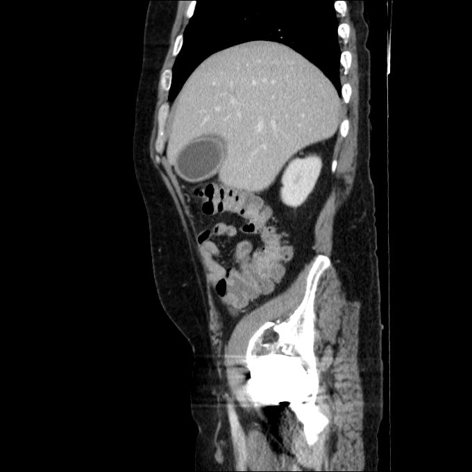 Acute cholecystitis and incidental left sided IVC (Radiopaedia 49352-54459 Sagittal C+ portal venous phase 69).jpg