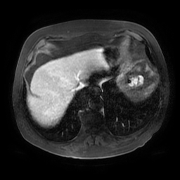 Acute cholecystitis complicated by pylephlebitis (Radiopaedia 65782-74915 Axial arterioportal phase T1 C+ fat sat 11).jpg
