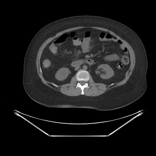 Acute cholecystitis with tensile fundus sign (Radiopaedia 71394-81723 Axial non-contrast 38).jpg