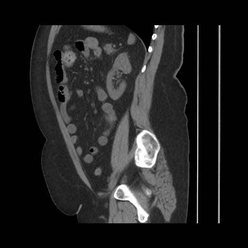 Acute cholecystitis with tensile fundus sign (Radiopaedia 71394-81723 Sagittal non-contrast 112).jpg