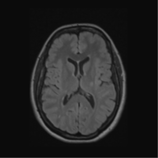 Acute disseminated encephalomyelitis (ADEM) (Radiopaedia 38073-40065 Axial FLAIR 35).png