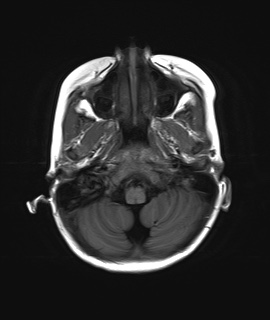 File:Acute disseminating encephalomyelitis with bilateral optic neuritis (Radiopaedia 79676-92886 Axial T1 4).jpg