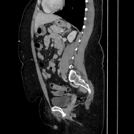 Acute diverticulitis - transverse colon (Radiopaedia 87063-103327 Sagittal C+ portal venous phase 139).jpg