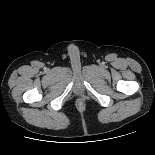 File:Acute diverticulitis with localized perforation (Radiopaedia 41296-44113 Axial C+ portal venous phase 98).jpg