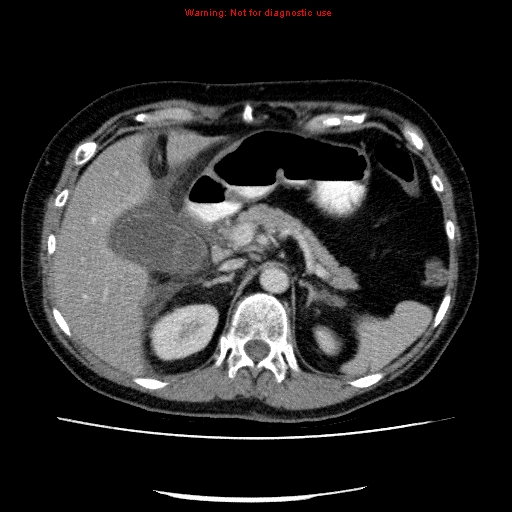 Acute gangrenous cholecystitis (Radiopaedia 10123-10661 Axial C+ portal venous phase 29).jpg