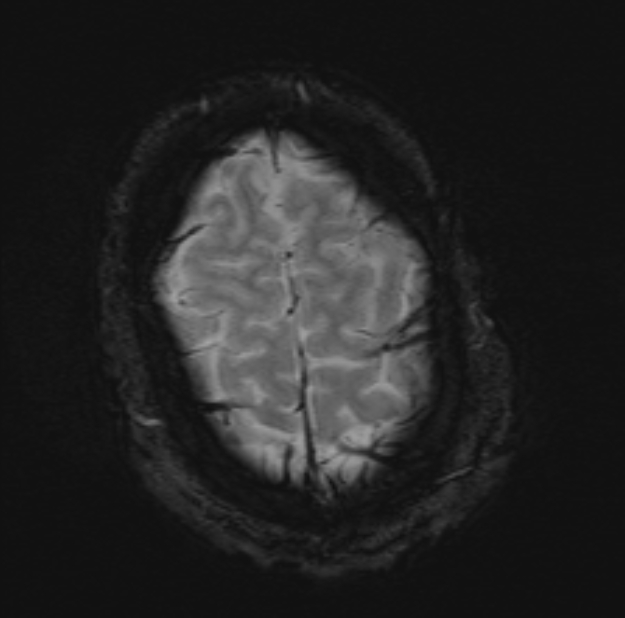 Acute ischemic stroke - posterior circulation territory (Radiopaedia 77670-89880 Axial SWI 51).jpg