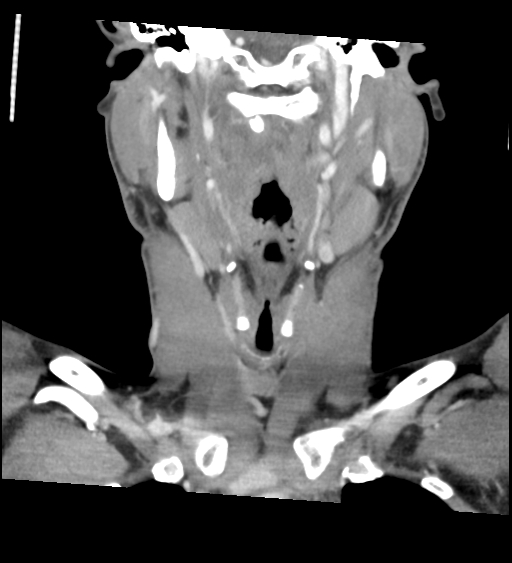 Acute longus colli calcific tendinitis (Radiopaedia 72495-83036 Coronal C+ arterial phase 27).jpg