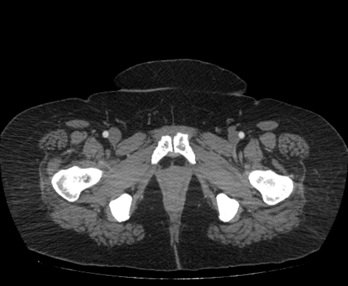 Acute mesenteric ischemia (Radiopaedia 80029-93316 Axial C+ arterial phase 139).jpg