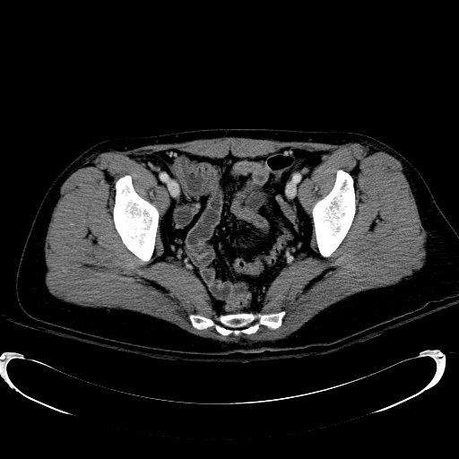 Acute myocardial infarction in CT (Radiopaedia 39947-42415 Axial C+ portal venous phase 115).jpg