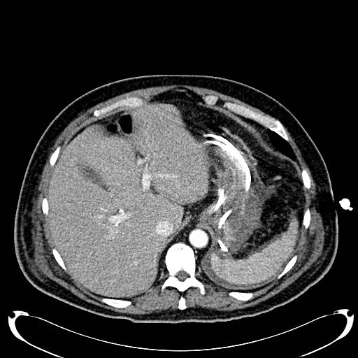 Acute pancreatic necrosis (Radiopaedia 13560-18500 Axial C+ portal venous phase 34).jpg