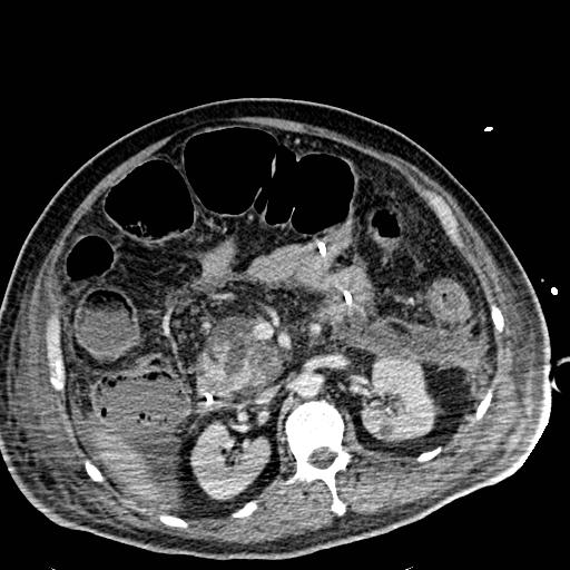 Acute pancreatic necrosis (Radiopaedia 13560-18501 Axial C+ portal venous phase 56).jpg