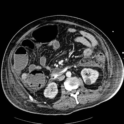Acute pancreatic necrosis (Radiopaedia 13560-18502 Axial C+ portal venous phase 49).jpg