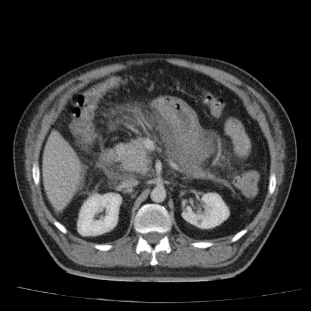 Acute pancreatitis (Radiopaedia 26663-26813 Axial C+ portal venous phase 31).jpg