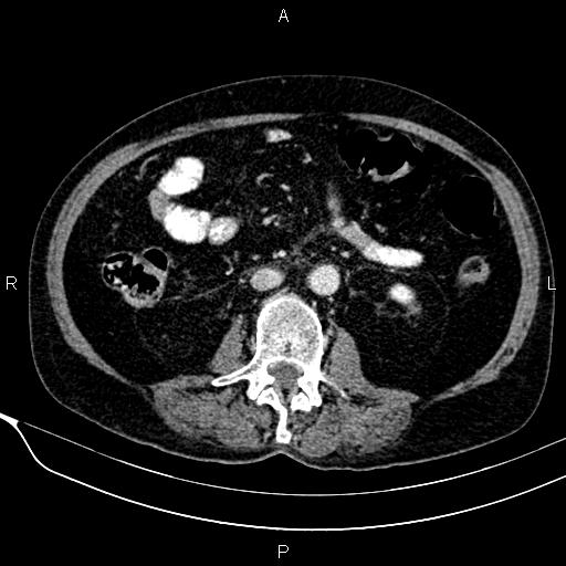 Acute pancreatitis (Radiopaedia 85146-100701 Axial C+ portal venous phase 36).jpg