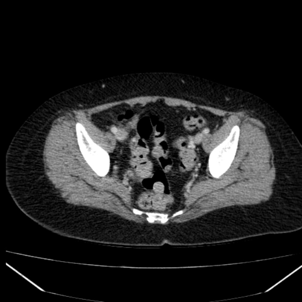 Acute pancreatitis - Balthazar C (Radiopaedia 26569-26714 Axial C+ portal venous phase 83).jpg