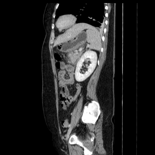 Acute pancreatitis - Balthazar C (Radiopaedia 26569-26714 Sagittal C+ portal venous phase 48).jpg
