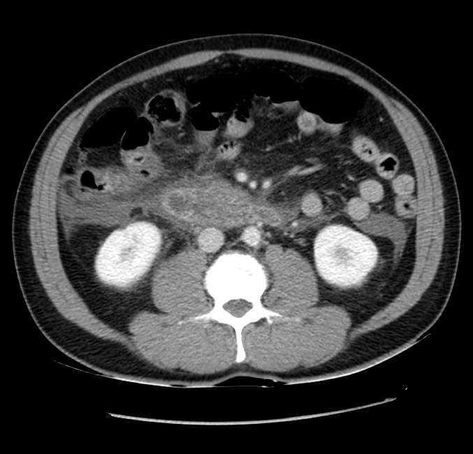 Acute pancreatitis - Balthazar E (Radiopaedia 23080-23110 Axial C+ portal venous phase 35).jpg
