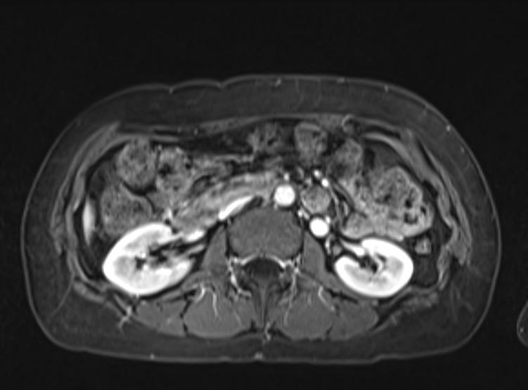 Acute pancreatitis - Balthazar E - post ERCP (Radiopaedia 27562-27778 F 58).png