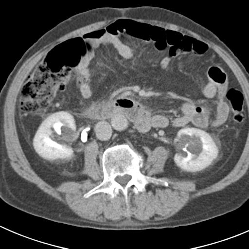 File:Acute pancreatitis and walled-off necrosis (Radiopaedia 29888-30403 Axial C+ delayed 43).jpg