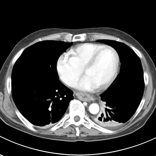 File:Acute pancreatitis and walled-off necrosis (Radiopaedia 29888-30404 Axial C+ portal venous phase 2).jpg