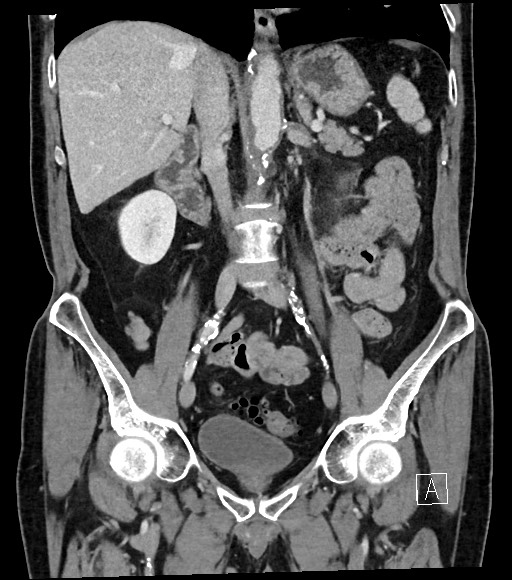 Acute renal infarction (Radiopaedia 59375-66736 Coronal C+ portal venous phase 33).jpg