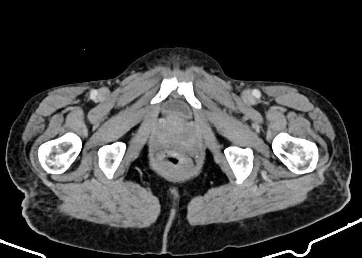 Acute small bowel (ileal) volvulus (Radiopaedia 71740-82139 Axial C+ portal venous phase 204).jpg