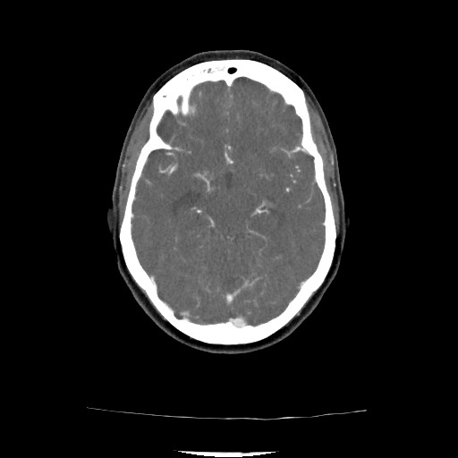 Acute subarachnoid hemorrhage and accessory anterior cerebral artery (Radiopaedia 69231-79009 Axial C+ arterial phase 93).jpg