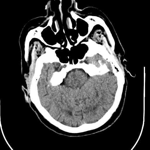 Acute vertebrobasilar ischemic infarction (Radiopaedia 25220-25473 Axial non-contrast 19).jpg