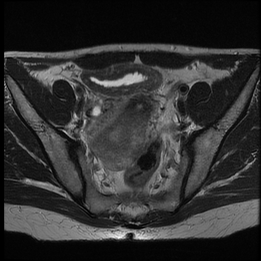 File:Adenocarcinoma arising in a urethral diverticulum (Radiopaedia 12400-12657 Axial T2 4).jpg