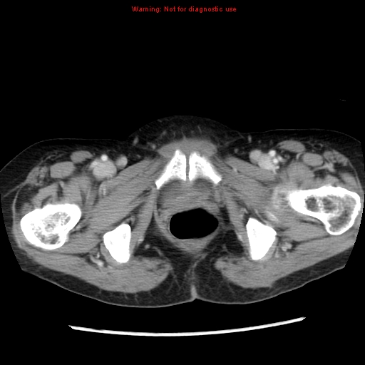 File:Adenocarcinoma of the colon (Radiopaedia 8191-9039 Axial liver window 76).jpg
