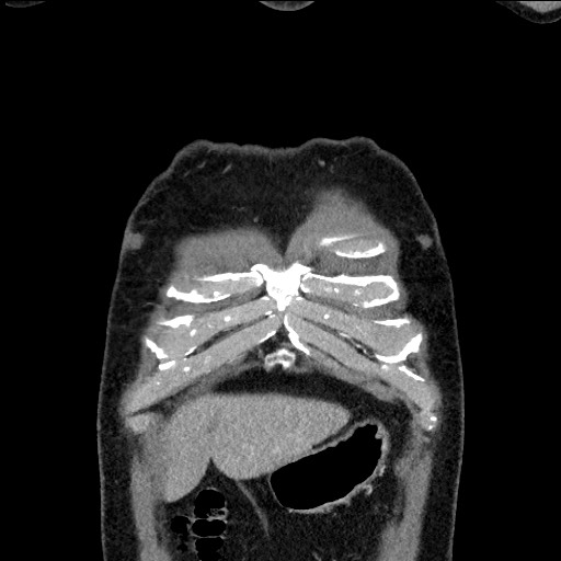 File:Adenocarcinoma of the lung (Radiopaedia 59871-67325 Coronal C+ arterial phase 3).jpg